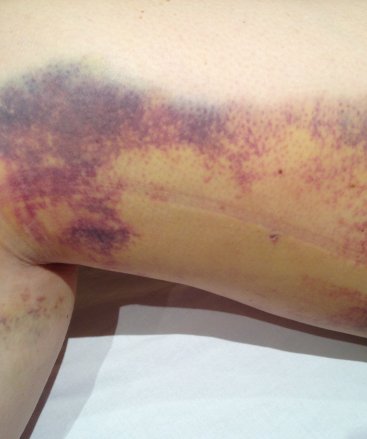 Bruising and Swelling: Plastic Surgery - The Movement Clinic | The